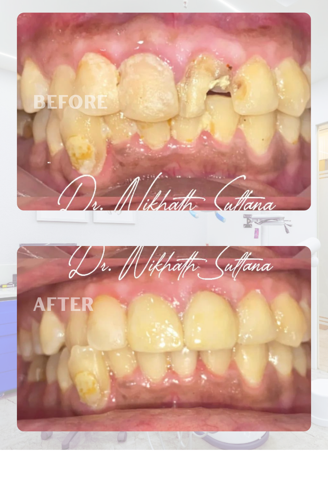 Before and After Smile