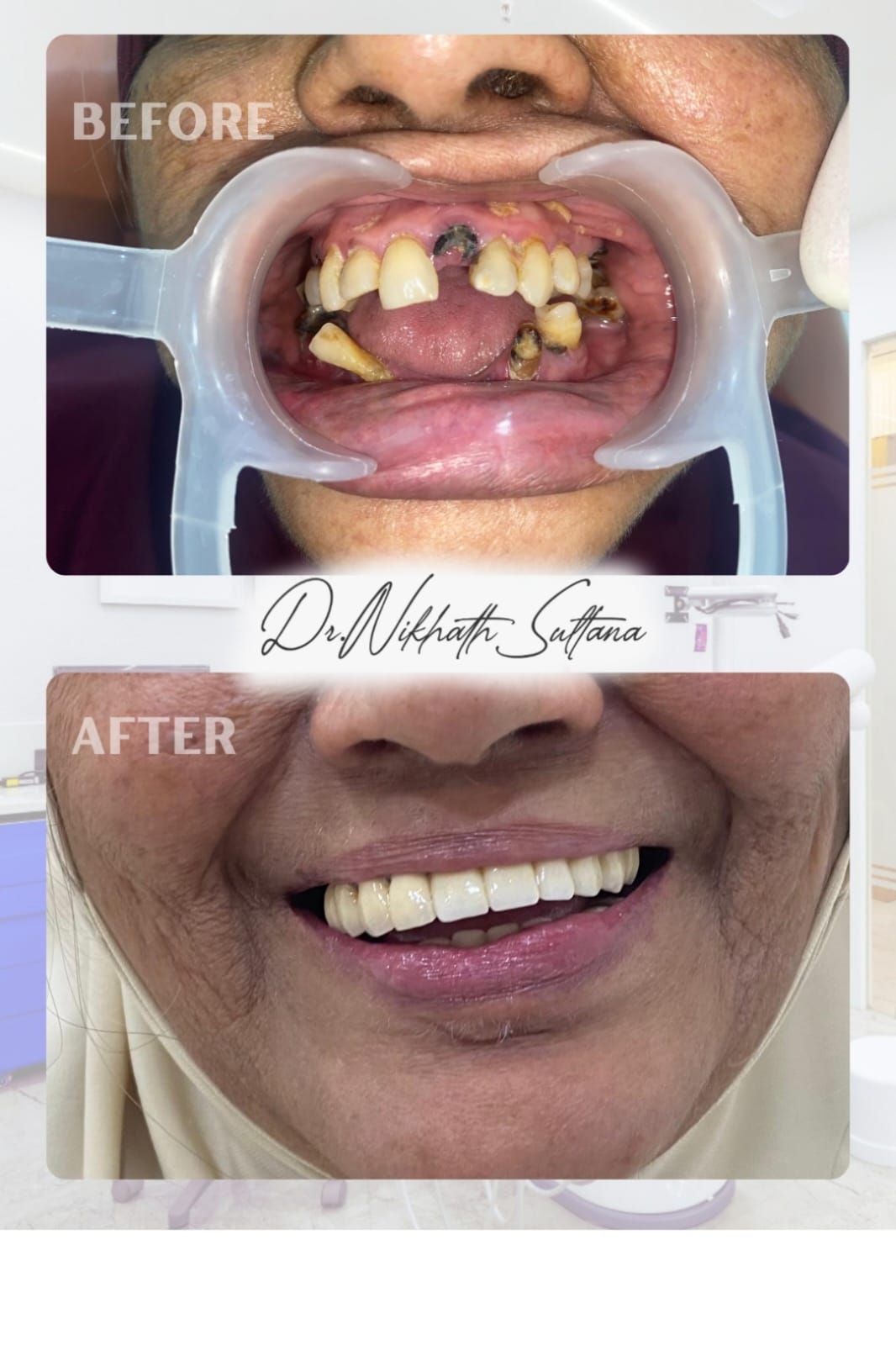 Single Dental Implant Case
