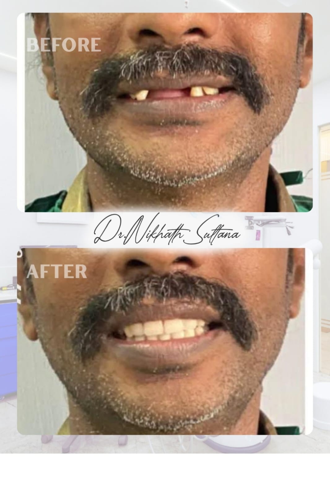 Complete Smile Makeover Transformation